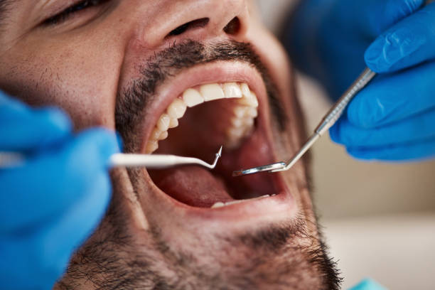Best Emergency Tooth Extraction in Carterville, MO